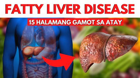 Ano ang gamot sa fatty liver